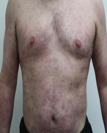 A man showcasing an extensive area of skin on his chest, emphasizing distinct anatomical features.