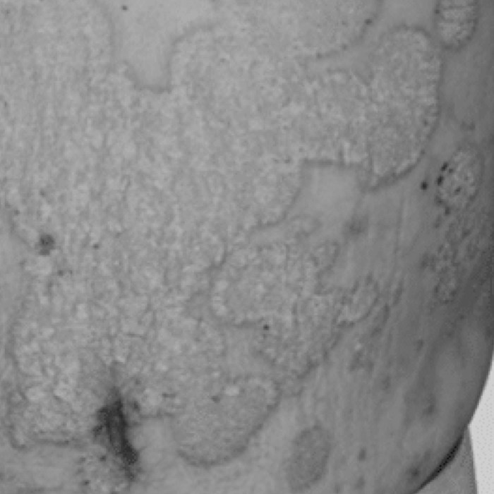 A man displaying numerous white spots on his stomach, highlighting a unique skin condition or pattern.